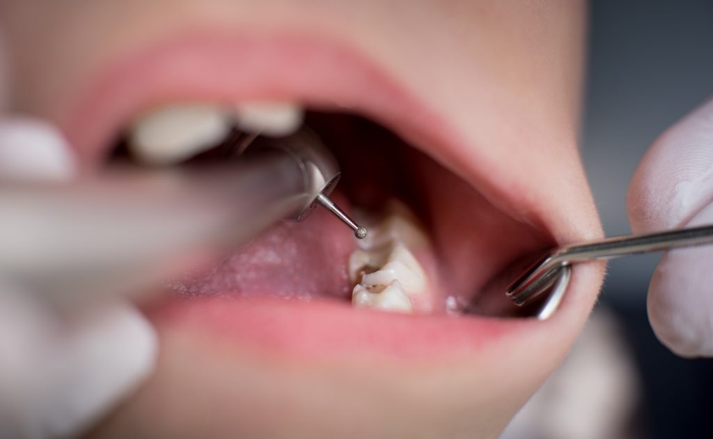 obturación dental