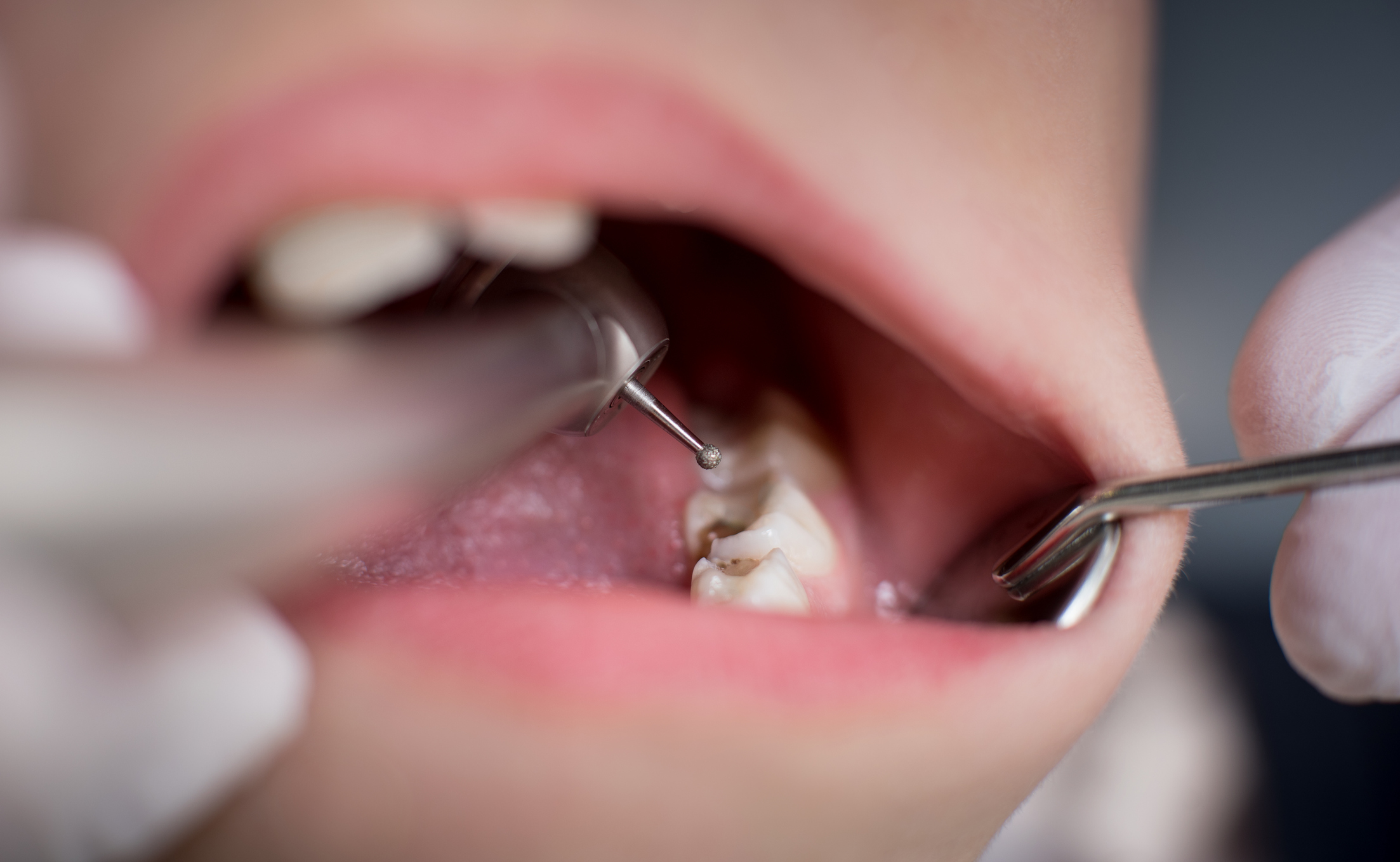 obturación dental