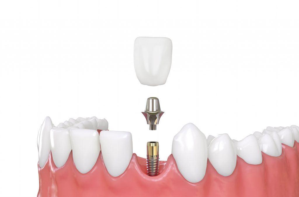 implantes dentales en El Pilar