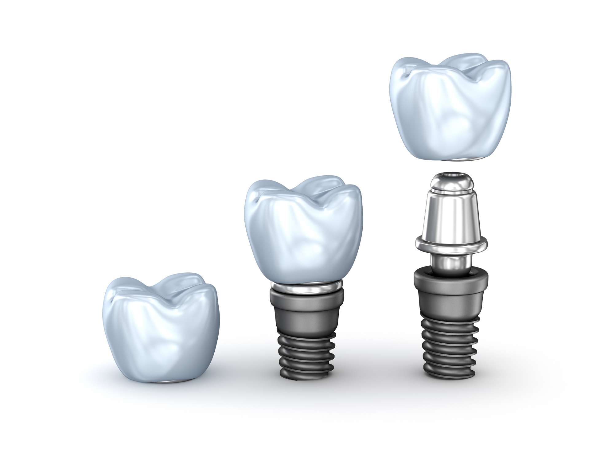 implantes dentales en El Pilar