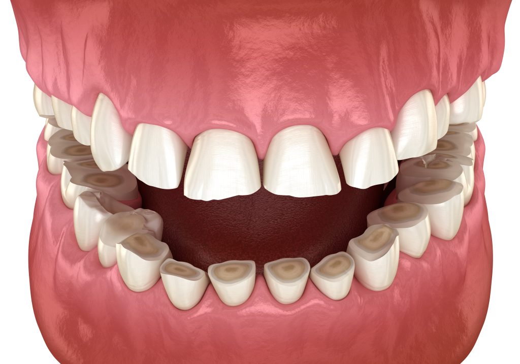 erosión dental