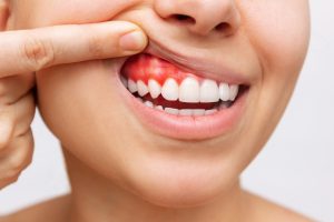 gingivitis