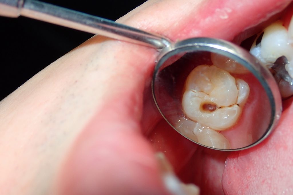 caries
