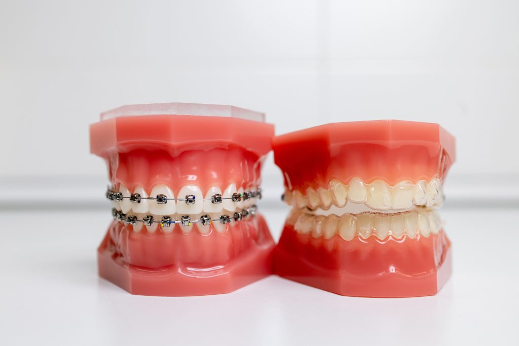 ortodoncia invisible y brackets