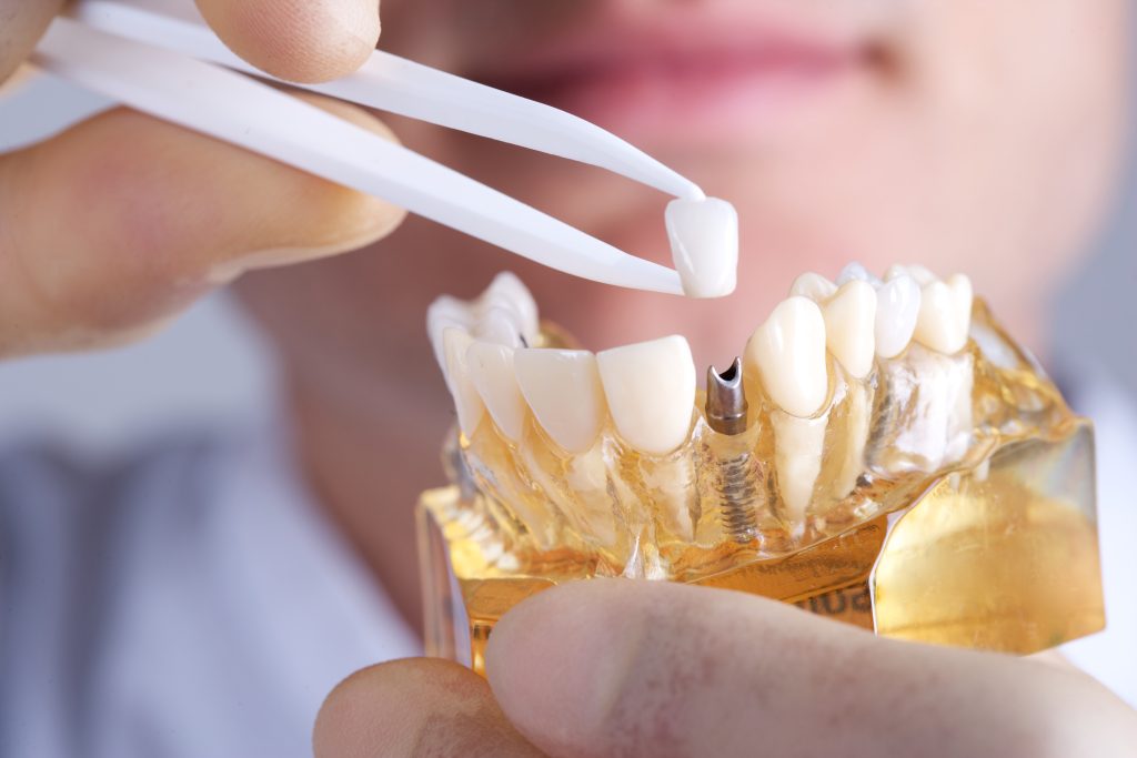 cuidados implantes dentales