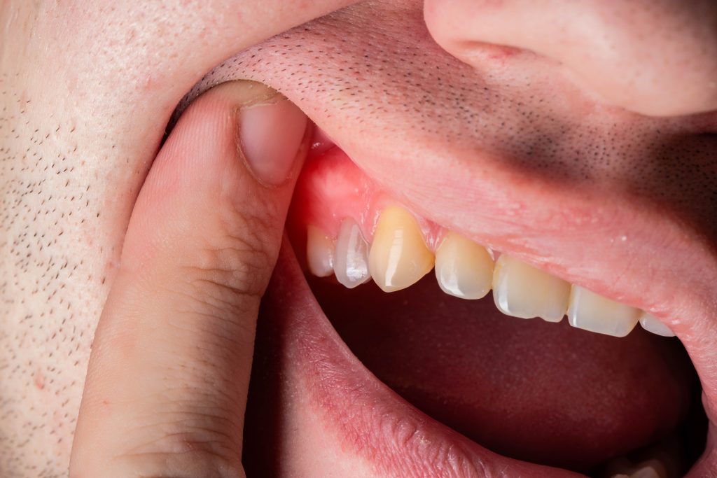Periodontitis