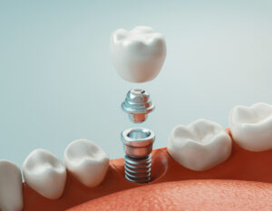 Prótesis removibles vs. implantes dentales