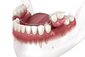 Prótesis removibles vs. implantes dentales