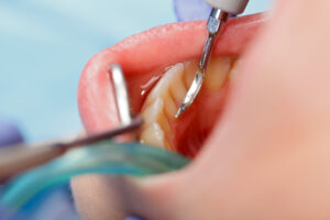 ¿Qué es el sarro dental y cómo eliminarlo?
