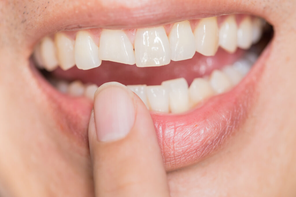 ¿Qué hacer en caso de sufrir una fractura dental?