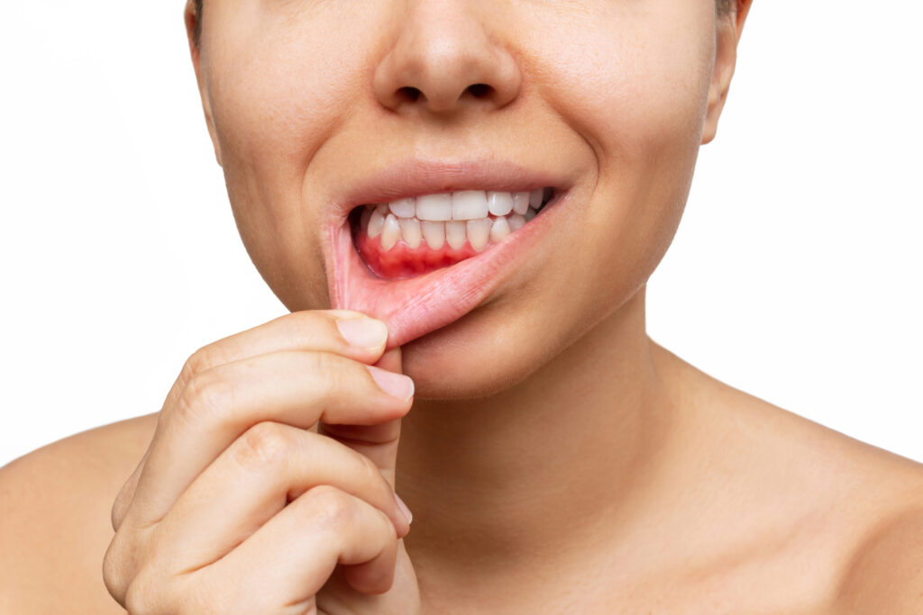 enfermedad periodontal