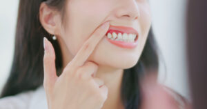 periodontitis