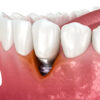 mucositis periimplantaria