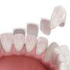 carillas dentales