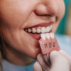 diferencia entre carilla y corona dental comparativa