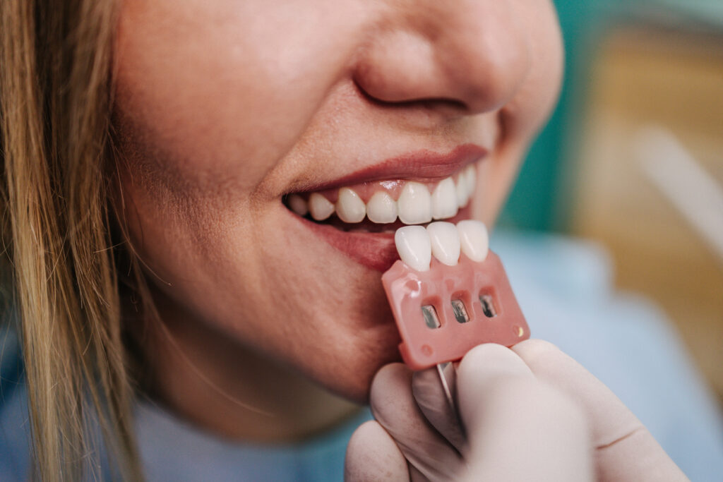 diferencia entre carilla y corona dental comparativa