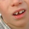 mitos sobre las carillas dentales y diseño de sonrisa